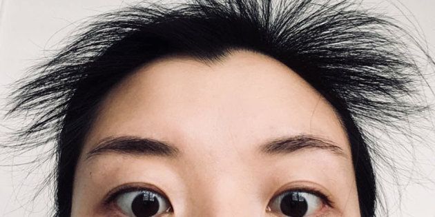 Excessive hair fall after childbirth